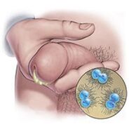 gonorrhea epidemic